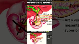 Pancreatitis Aguda por cálculos biliares doctor pancreatitis fisiopatologia [upl. by Aihsei495]