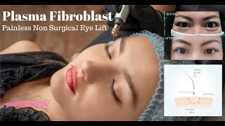 Plasma Fibroblast Non Surgical Blepharoplasty Eyelift Treatment amp Training Singapore [upl. by Emyle]