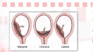 Dr Ignacio Pérez Tomasone ¿Qué es la placenta previa [upl. by Irem]