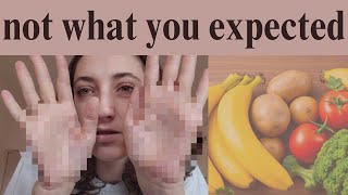 i STOPPED eating these foods and my eczema healed [upl. by Eelytsirk]