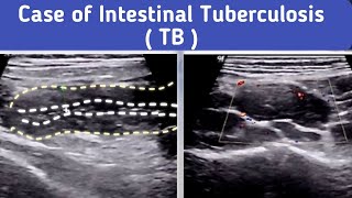 Ultrasound Intestinal Tuberculosis TB [upl. by Fleda326]