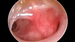 Otoendoscopy of Retracted Ear Drum with Multiple Perforations [upl. by Nylssej]