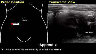 How To Scan Appendix  Ultrasound Probe Positioning  Transducer Placement  Abdominal USG Scanning [upl. by Oijimer]