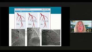 SCAD amp SCADAssociated Arteriopathy [upl. by Mouldon392]