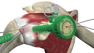 Biceptor Tenodesis System  Surgical Technique Walkthrough  SIMON MOYES [upl. by Flanders]