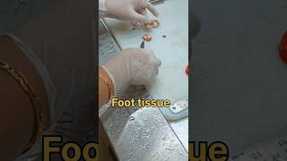 Foot tissue biopsy [upl. by Sell]