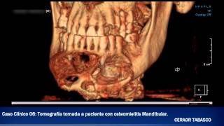 Caso Clínico 06  Tomografía tomada a Paciente con Osteomielitis Mandibular [upl. by Woodruff]