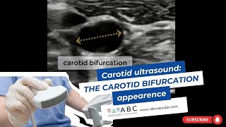 CAROTID ULTRASOUND THE CAROTID BIFURCATION [upl. by Cnahc27]