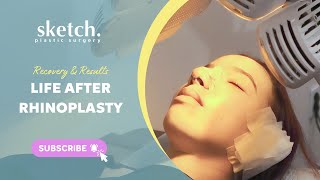 Life After Rhinoplasty in Korea  Recovery amp Results at Sketch Plastic Surgery [upl. by Upton394]