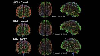 Jordi Marinez and Prarthna Chabria Diffusion MRI in Callosal Agenesis [upl. by Malcah]