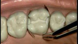 Dentsply  Palodent Demonstration on a dental model [upl. by Boleslaw]