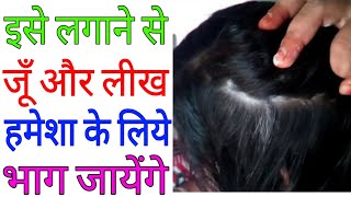 जूँ और लीख से हमेशा के लिए छुटकारा पायें  balo se jue nikalne ka tarika  how to remove jue [upl. by Rad]