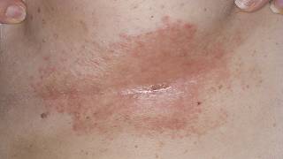 DermTV  How to Treat Under Breast Rashes amp Infections DermTVcom Epi 190 [upl. by Eitra]