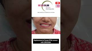 Smile Makeover with Zirconia Crowns smiledesign smile [upl. by Astiram255]