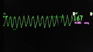 ventricular tachycardia  Torsade de Pointes on an ECG heart monitor [upl. by Scully653]