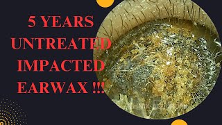 5 YEARS Untreated Impacted Earwax Very Satisfying Result [upl. by Willey217]