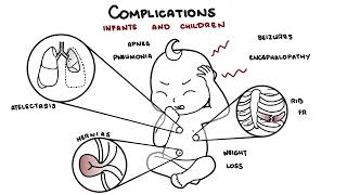 What is Pertussis and whooping cough  Bordetella pertussis symptoms pathophysiology and treatment [upl. by Ogaitnas510]