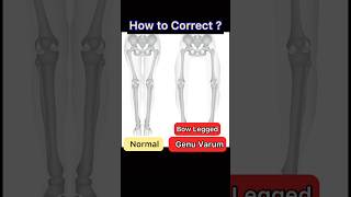 Bow Legs Correction Genu Varum Exercise [upl. by Adialeda240]