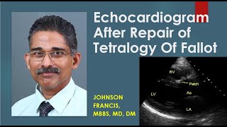 Echocardiogram After Repair of Tetralogy Of Fallot [upl. by Esta]