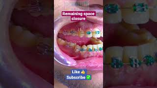 Orthodontic space closure 👉 loop mechanics orthodontics dentist [upl. by Zebedee635]