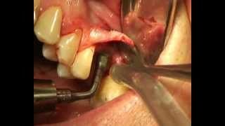 Intralift internal sinus lift procedure [upl. by Notlit]