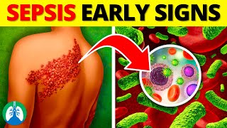 Top 10 Early Warning Signs of Sepsis  NEVER Ignore THIS [upl. by Gauntlett]