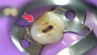 LIVE Root Canal Procedure under the Microscope w Specialist [upl. by Ferrigno]