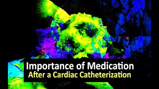 Importance of Medication After a Cardiac Catheterization [upl. by Druci]