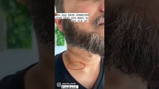 Watch me remove my skin tag  Before amp after removal from home [upl. by Jodi228]