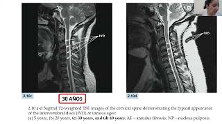 SPINE WEBINAR 64 DISCOPATIA CERVICAL INDICACIONES DE MALLAS DE EXPANSION VS CAJAS INTERSOMATICAS [upl. by Surad]