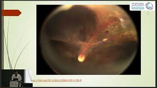 High Myopia Related RRD and Associated Syndromes [upl. by Sidra]