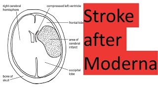 Stroke and death after Moderna [upl. by Jemma]