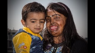 Acid Attack Survivor Finds Love [upl. by Seyler]