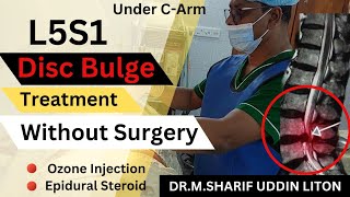 L5S1 Disc Bulge Treatment without Surgery L5s1 Transforamianal Steroid Injection  Ozone Therapy [upl. by Orelee448]