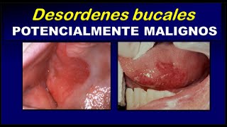 LESIONES ORALES POTENCIALMENTE MALIGNAS [upl. by Etnomaj]