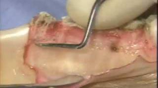 Introductory Periodontal Surgical Techniques The Apically Positioned Flap and Crown Lengthening [upl. by Adidnere]