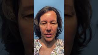 Patient with Meige syndrome facial spasms being treated with Botox [upl. by Hallagan]