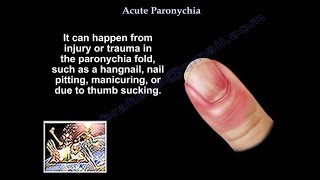 Paronychia  Everything You Need To Know  Dr Nabil Ebraheim [upl. by Aihsyn]