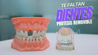 Como hacer protesis dental removible provisional con acrilico [upl. by Annawit]