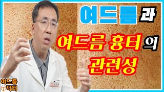 여드름과 여드름 흉터 관련성은❓여드름 여드름흉터 여드름흉터없애는방법 [upl. by Aseretairam]