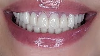 CUSHION GRIP UPDATE fyp foryou dentures short smallyoutuber shortvideo smile fyp [upl. by Yneffit]