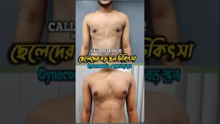 Gynecomastia surgery Bangladesh [upl. by Hollington]