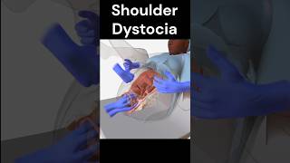 Shoulder Dystocia [upl. by Ressan]