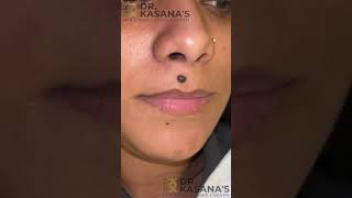 Mole Removal EXPERT Shares Top Secrets  DrLalit Kasanas [upl. by Xanthe]