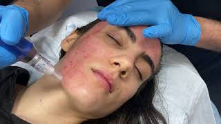 Microneedling using SkinPen and topical PRP for acne scars and skin rejuvenation by Dr Shaun Patel [upl. by Dianuj]