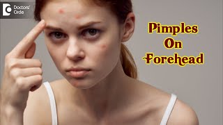 Pimples On Your Forehead Causes amp how to get rid of it  Dr Urmila Nischal  DoctorsCircle [upl. by Siuqram]