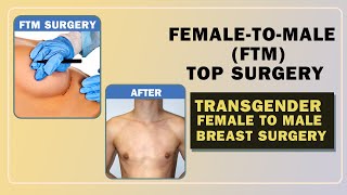 Female to Male Transformation  Femaletomale FTM top surgery in Delhi  Dr PK Talwar [upl. by Akener47]