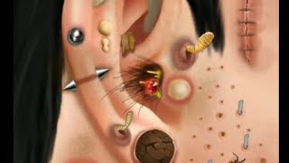 Itchy amp Smelly Ear Stone Removal Digging Out Super Big Earwax [upl. by Nauqyaj]