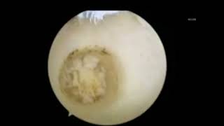 All Arthroscopic Osteochondral Autograft Transplantation for Medial Talar Dome Lesions Talus [upl. by Jeffrey320]