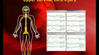 quotPatient Transparentquot Intraoperative Neurophysiological Monitoring in MISS [upl. by Areyk]